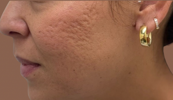 Before Pigmentation