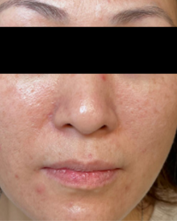 Before Pigmentation