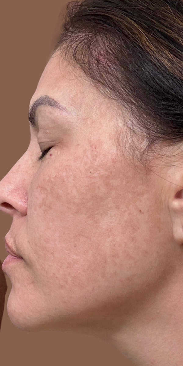 After Acne Scars