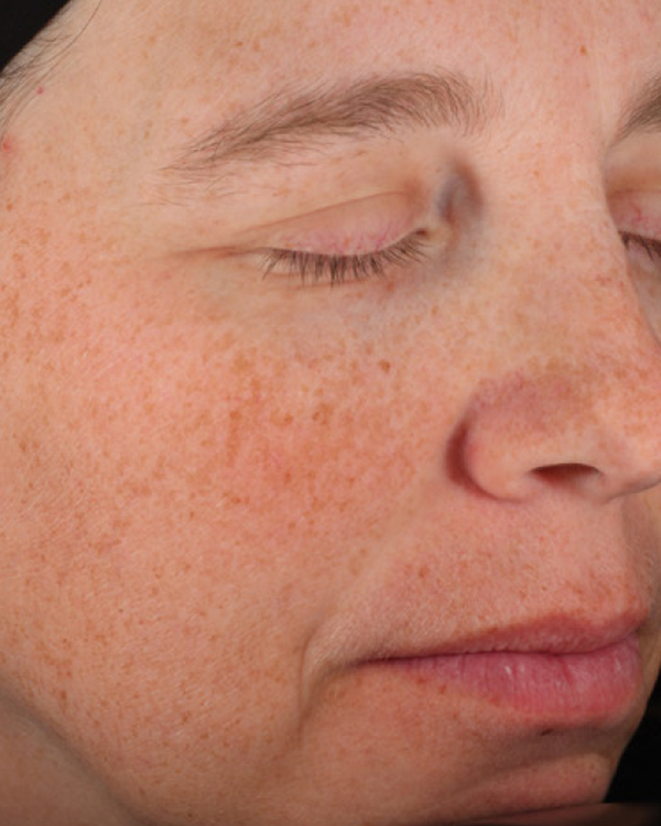 Before Acne Scars