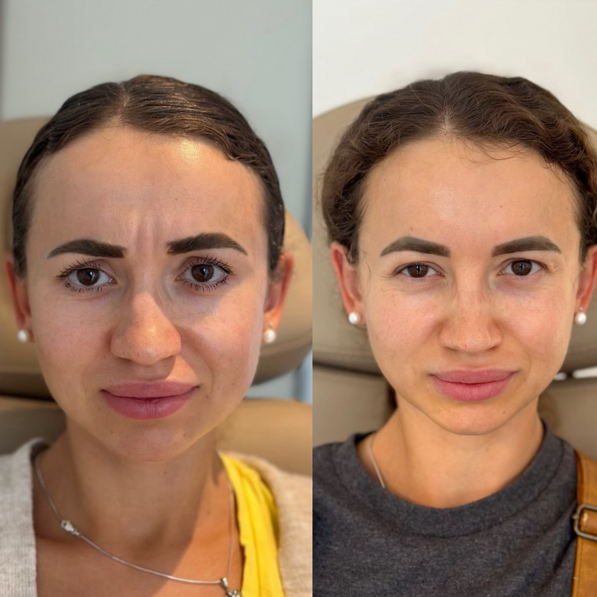 Before and After results of Glabella wrinkle relaxer tox treatment