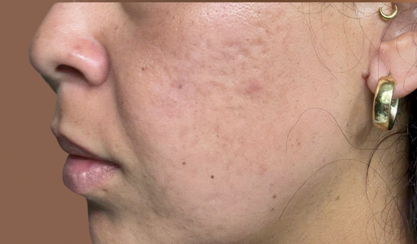 After Pigmentation