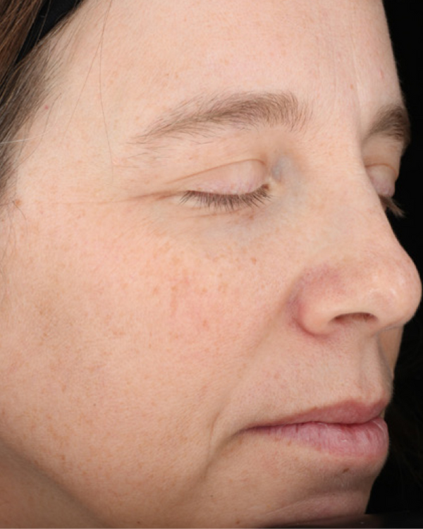 After Acne Scars