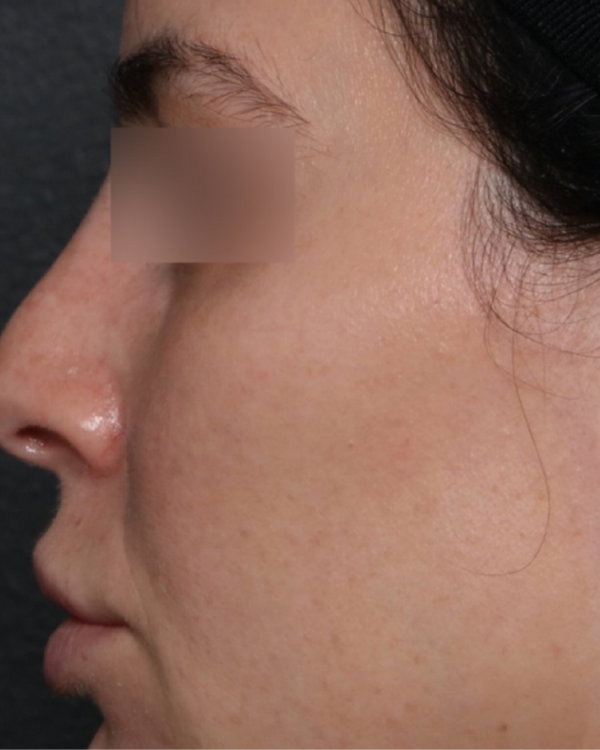 After Fine Lines & Wrinkles