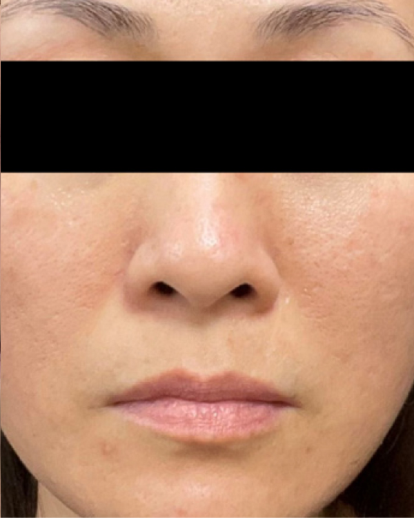 After Pigmentation