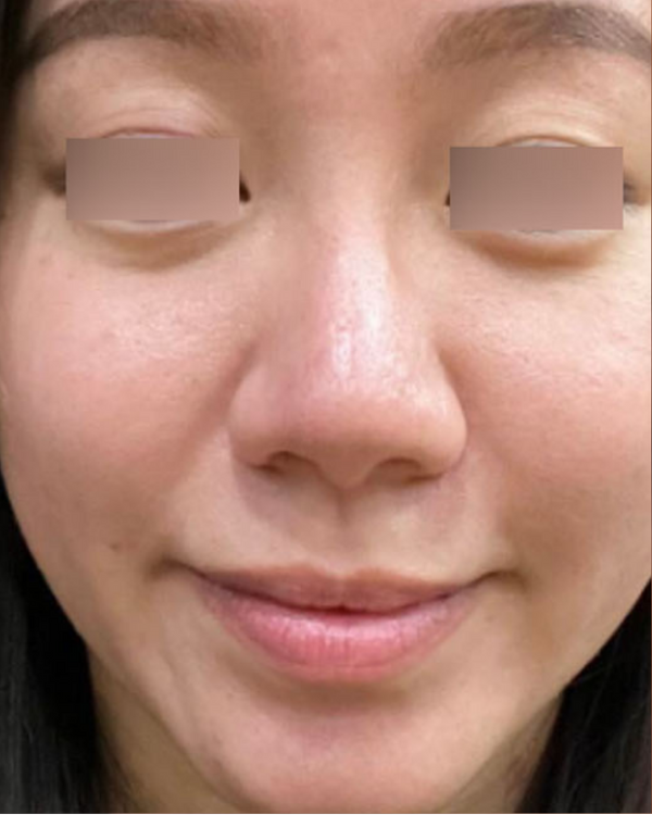 After Pigmentation