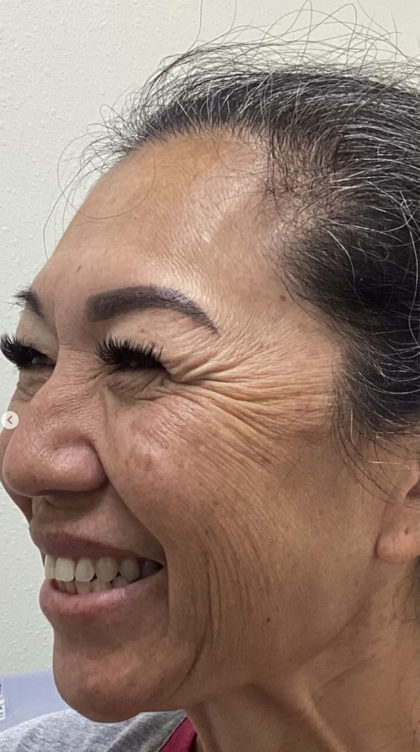 Before Fine Lines & Wrinkles