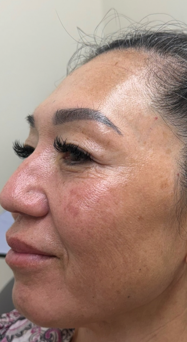 After Fine Lines & Wrinkles