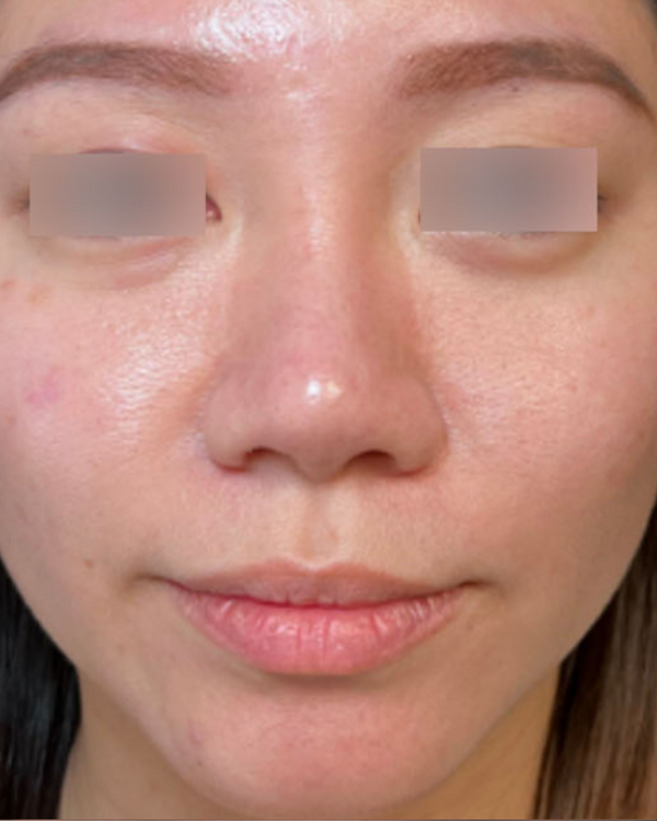 Before Pigmentation