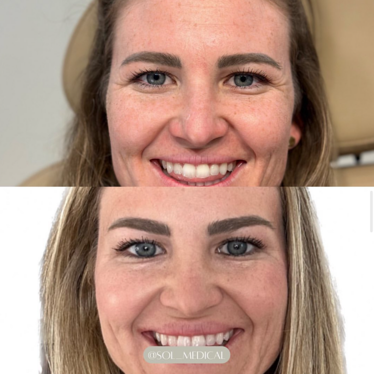 Before and After of forehead, glabella, crow feet, and lip flip botox treatment