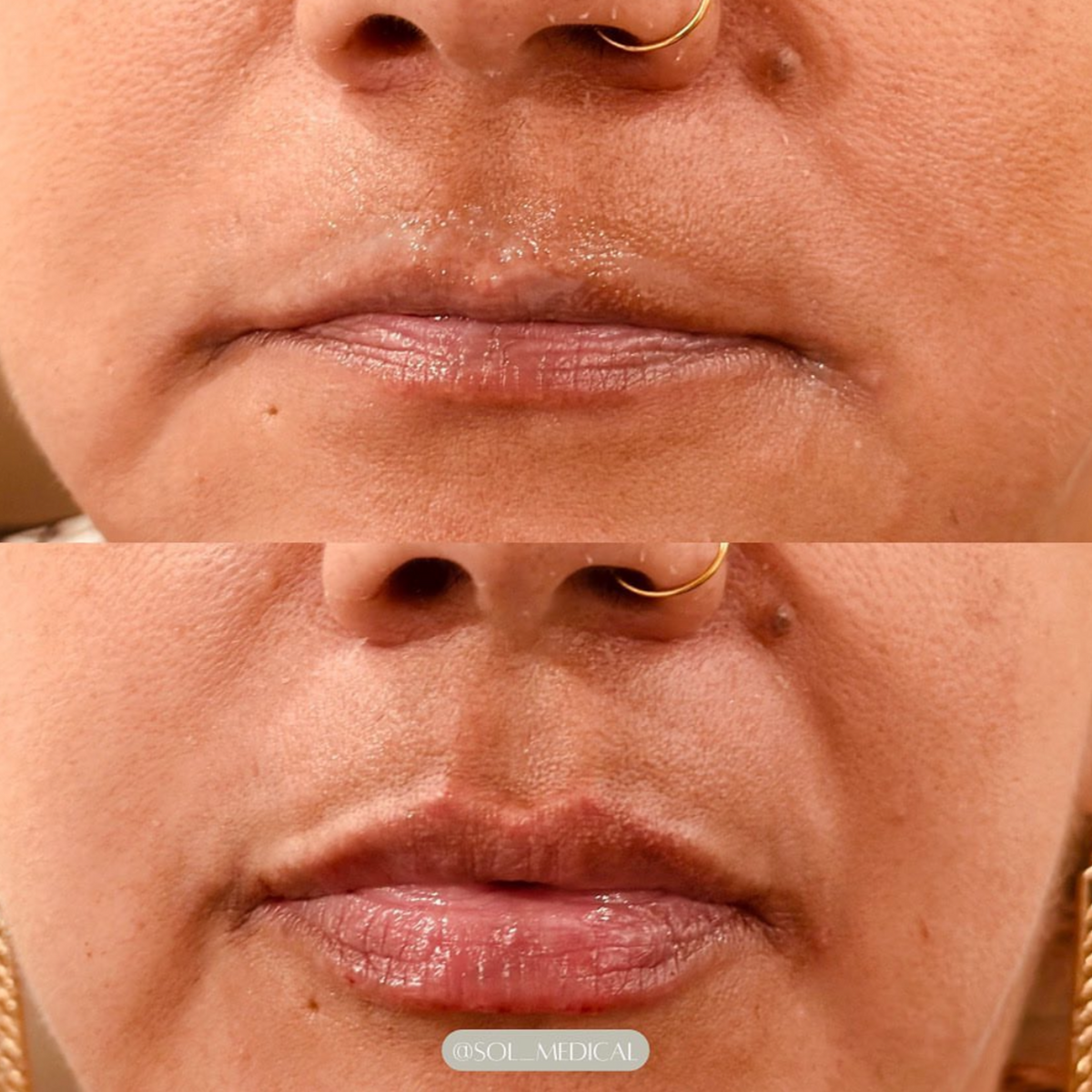 Before and After of Lip Filler with natural and plump results by Sol Medical Hawaii