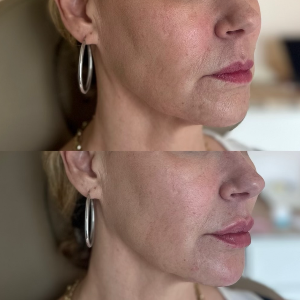Before and After of lower face balancing with filler on lips and chin by Sol Medical Hawaii
