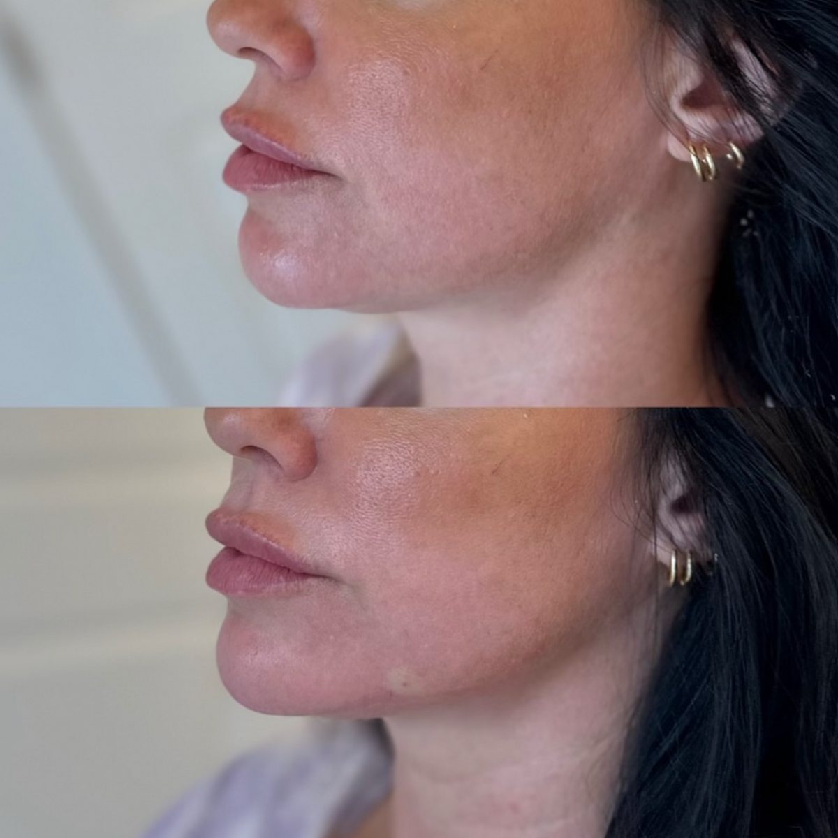 Before and After of Chin and Jawline enhancement with fillers by Sol Medical Hawaii
