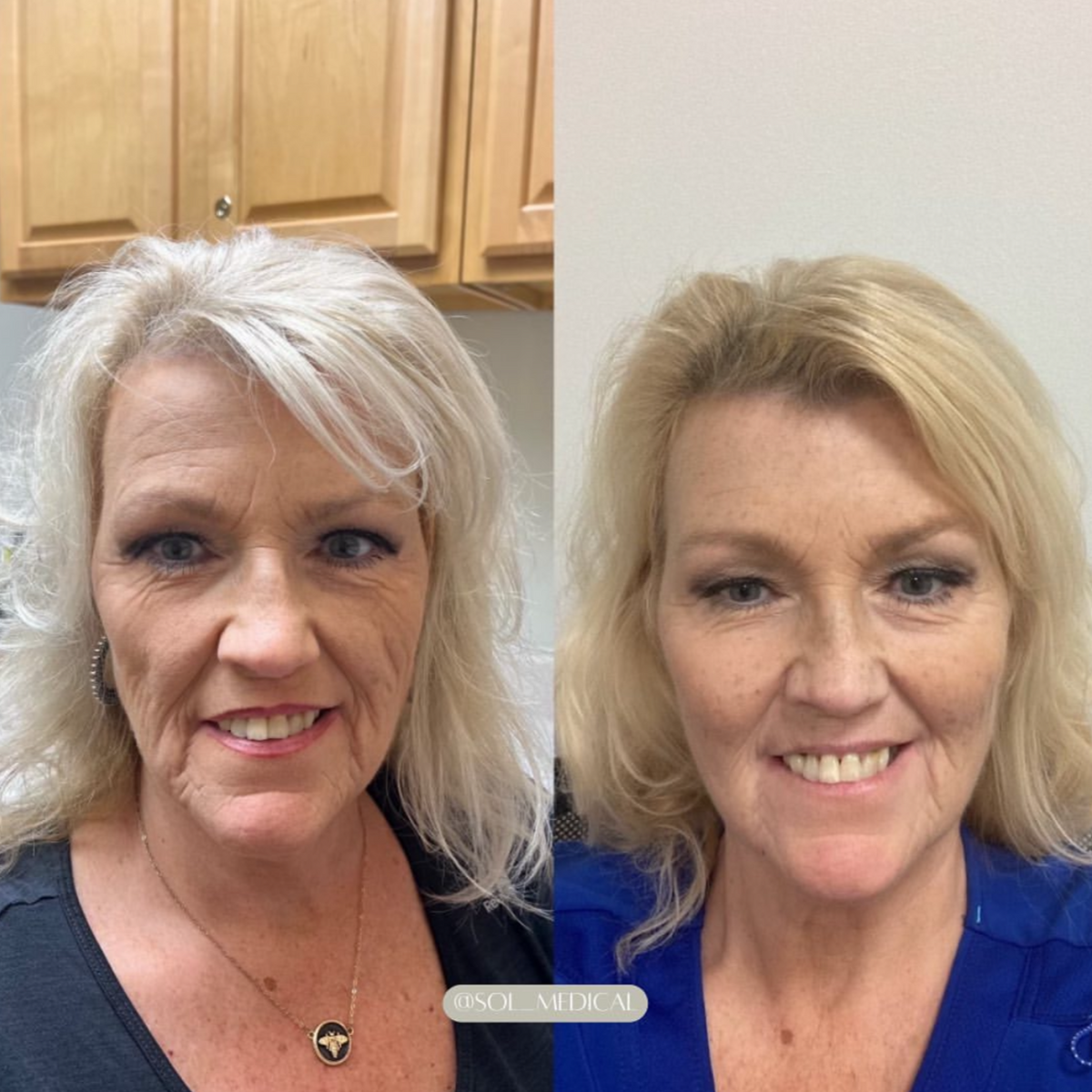 Before and After of Radiesse filler treatment on mature skin by Sol Medical Hawaii