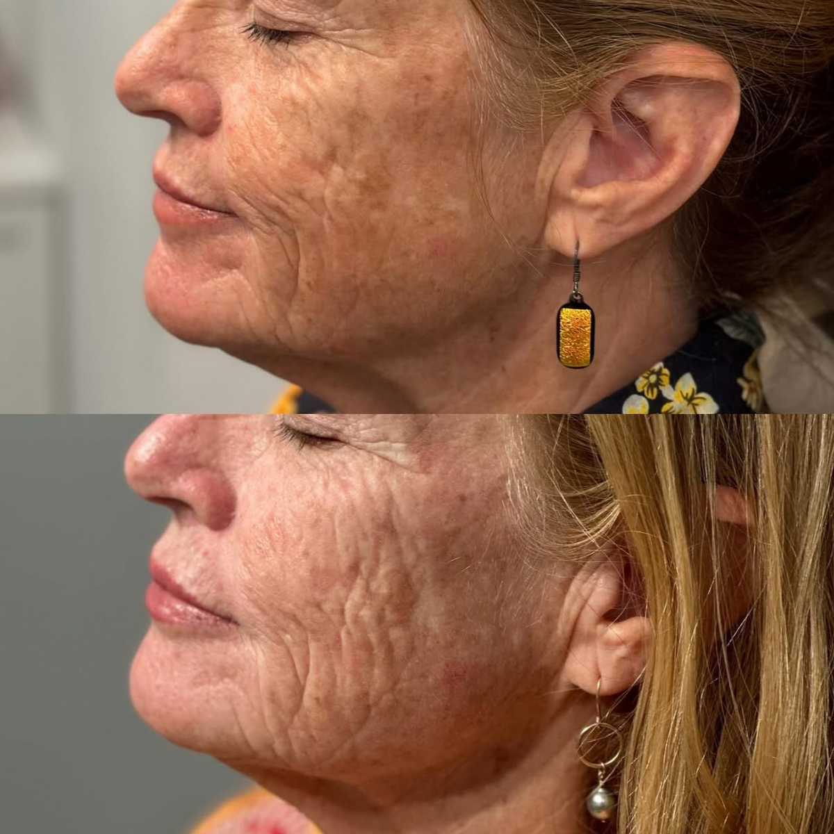 Before and After of Sculptra biostimulatory treatment on mature skin