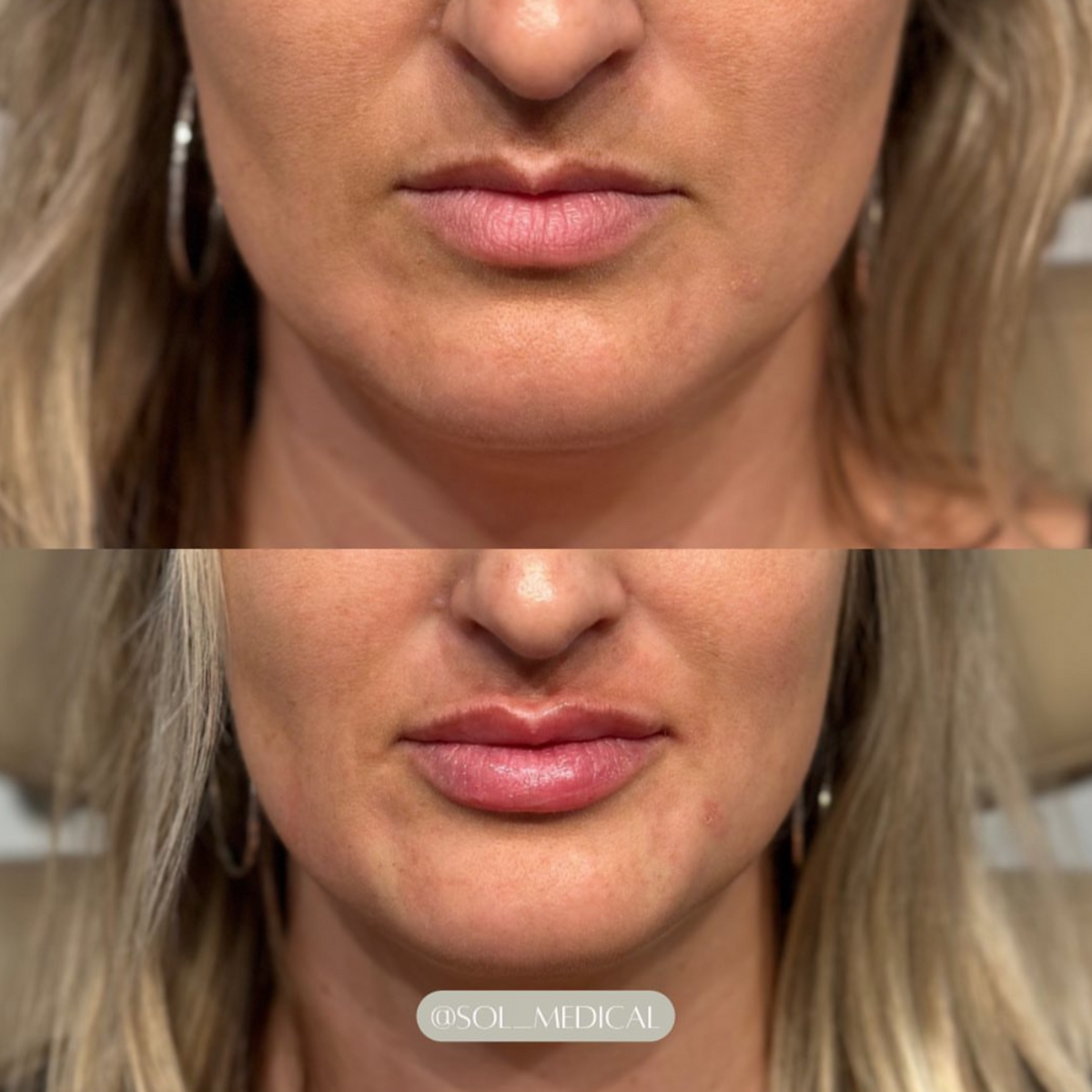 Before and After photo of natural and balanced lip filler results by Sol Medical Hawaii