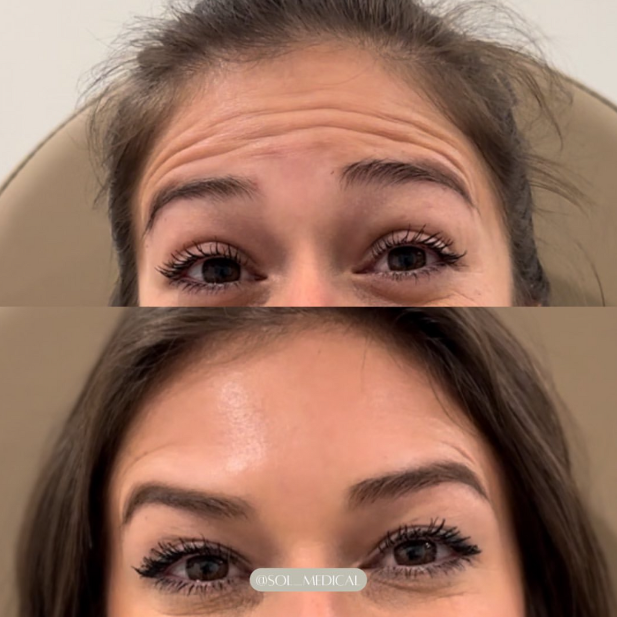 Before and After of wrinkle relaxation botox treatment on forhead