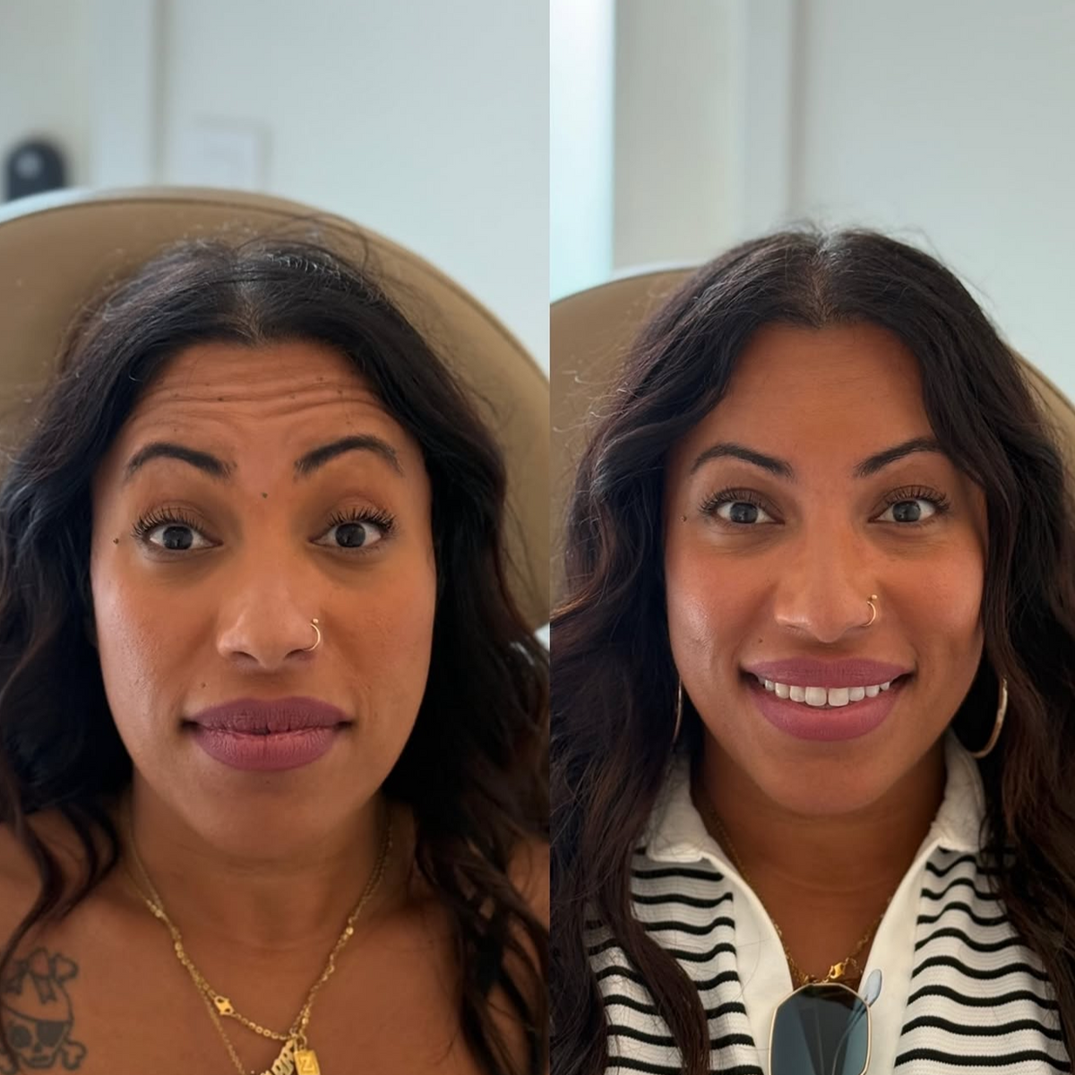 Before an After of forehead wrinkle botox treatment