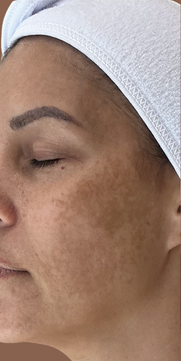 Before Acne Scars