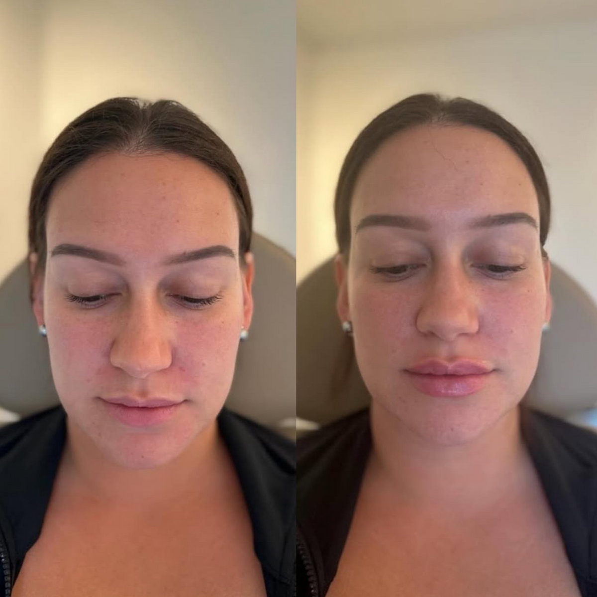 Before and After of natural lip filler treatment by Sol Medical Hawaii
