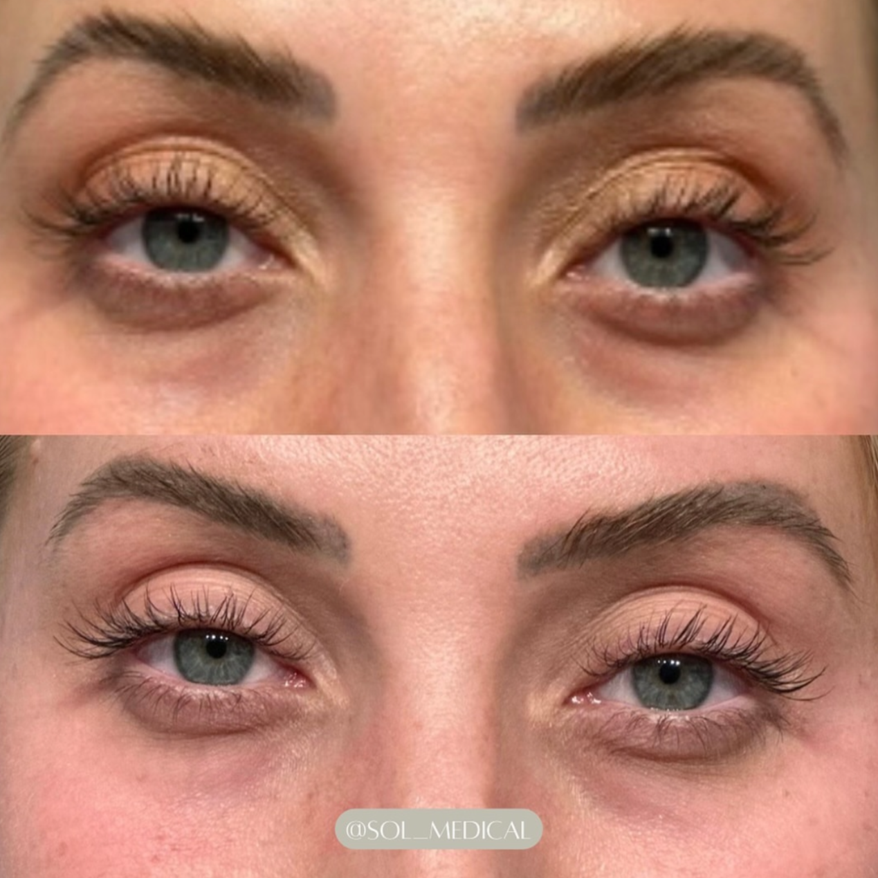 Before and After image of PRF tear trough refresh treatment