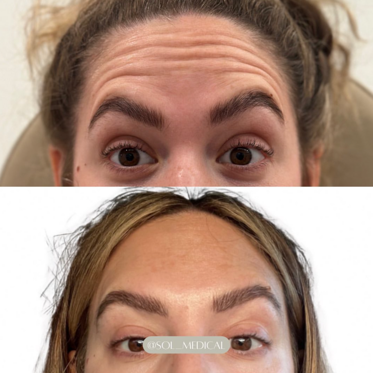 Before and After treatment of forehead wrinkle botox treatment