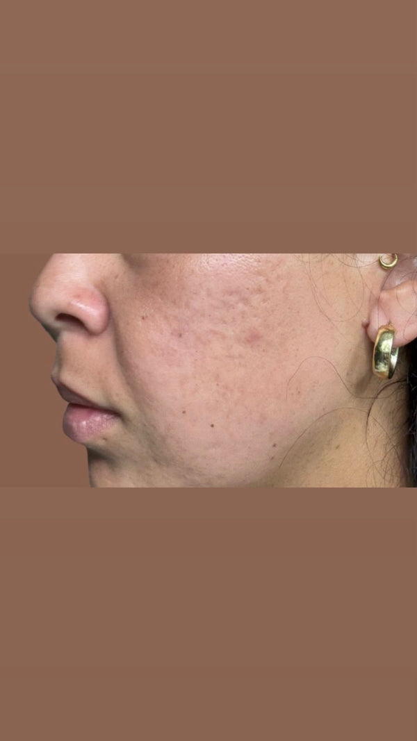 After Acne Scars