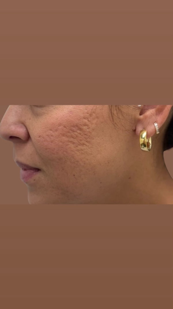 Before Acne Scars